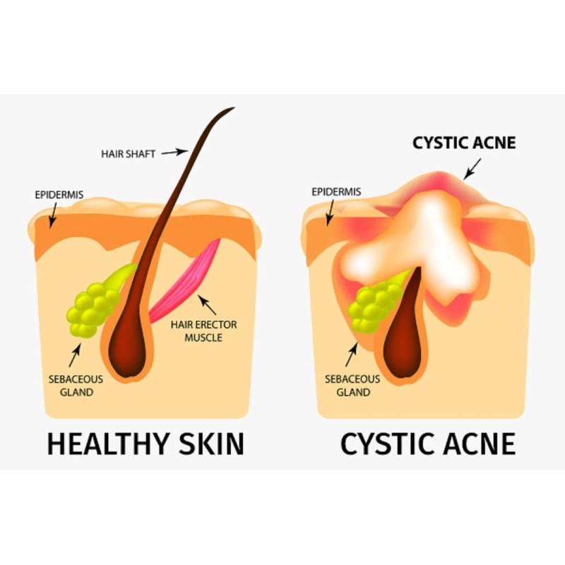 SUPPLEMENTS4ME ACNE QUISTICO SOLUCION HOMBRES Y MUJERES - Made in