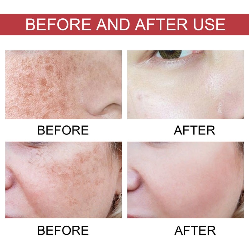 2pcs Dark Spot Correcting Serum with Niacinamide Hyperpigmentation Even Skin