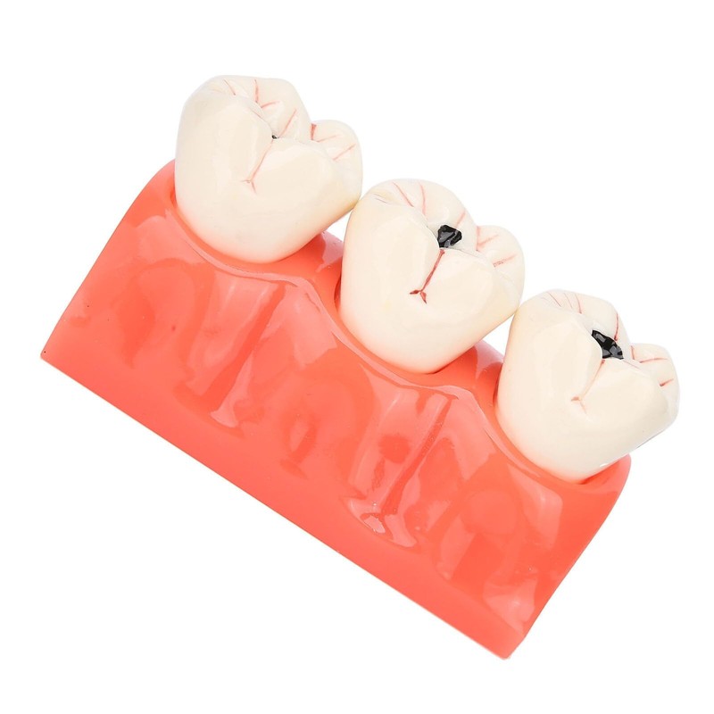 Tankredrug 4 Times Caries Evolution Model Detachable Teeth Disease Teach