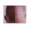 1pc Male Scalp Micropigmentation Practice Skin Man Bald SMP Training