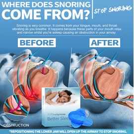 Anti-Snore Devices, Sleep Snoring Solutions - Stop Snoring for Effective Sleep-H23