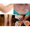 ISAL 3 Lot of ISAL Atopy Eczema Cream Lotion./Made in