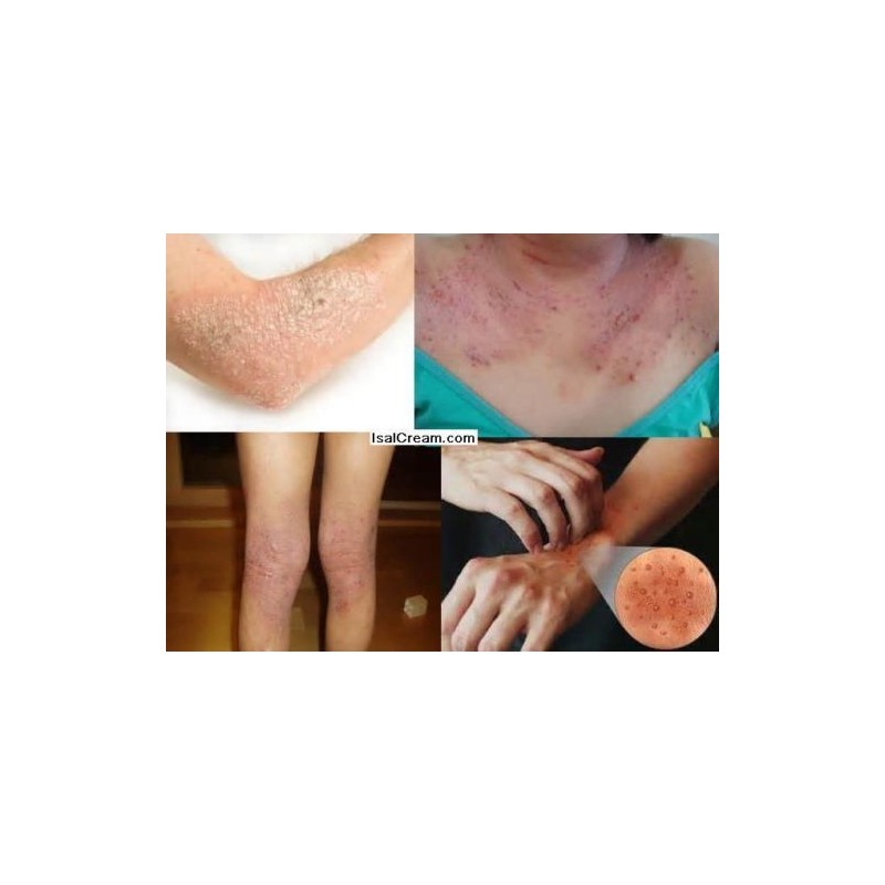 ISAL 3 Lot of ISAL Atopy Eczema Cream Lotion./Made in