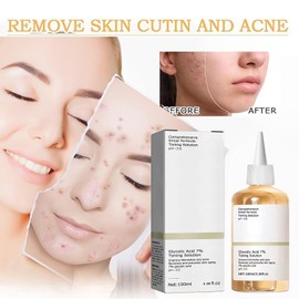 Glykolsäuretoner,Glycolic Acid Toning Resurfacing Solution,Peeling Toner,Glykolsäure Peeling 7%,Glycolic Acid 7% Toning Solution,Feuchtigkeitsspendendes Hautpflegeserum,für Hautunreinheiten und Akne