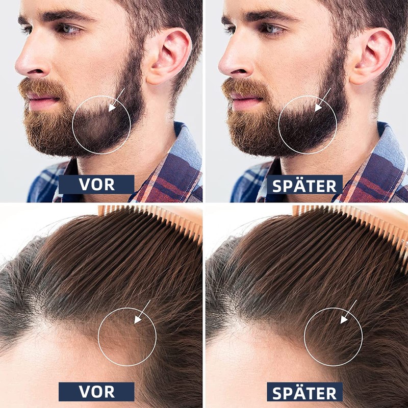 Beard Roller 0.5 mm, Derma Roller, Beard Roller, Beard Growth,