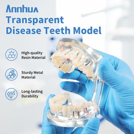 Annhua Transparent Disease Teeth Model for Dental Students, 32 Standard Typodont Teeth Model with Removable Crown Bridge, Pathological Teaching Models for Implant Education and Demonstration