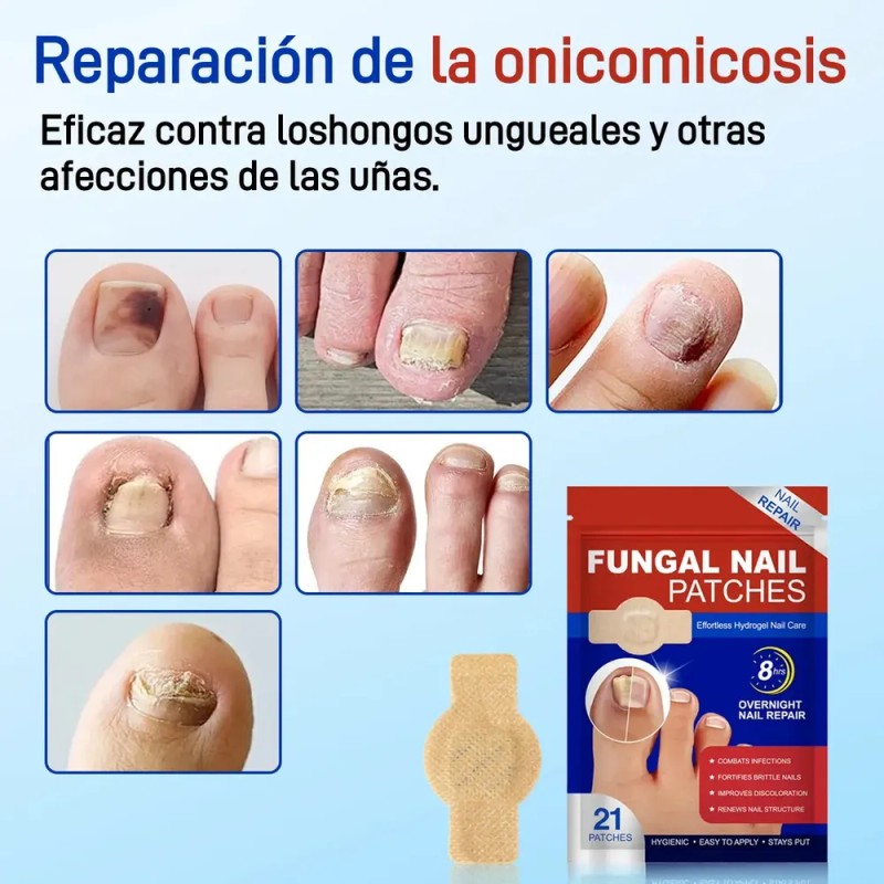 Culdsnia Parches Para Uñas Fúngicos De Parches 42 Pcs /