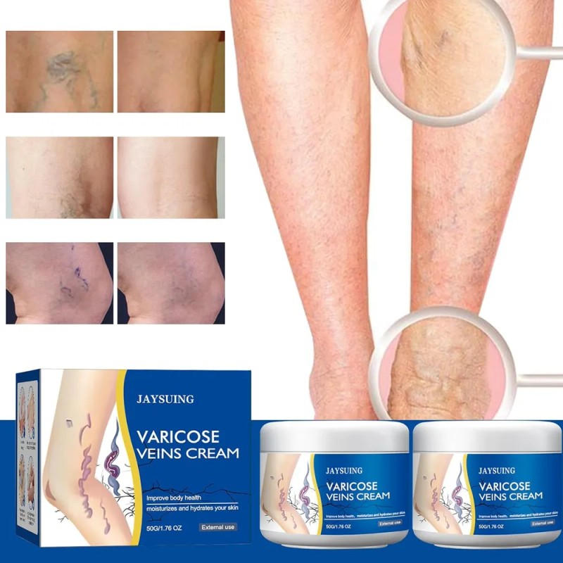 Crema De Varices Para Piernas, Cuidado Hidratante De La Piel