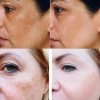 Esencia Facial 4 En 1 Que Elimina Manchas Y Humecta