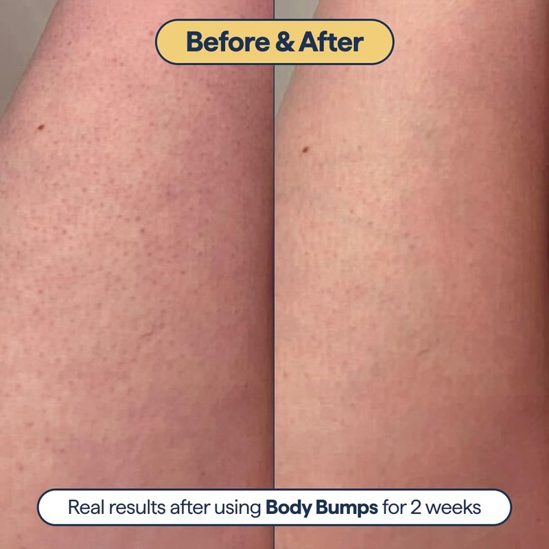 Remedy for Body Bumps – Treatment for Keratosis Pilaris (KP)