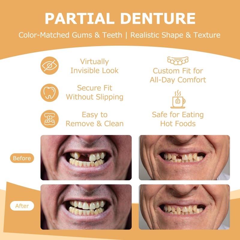 Partial Dentures - Dentures for Missing Teeth & Gaps -