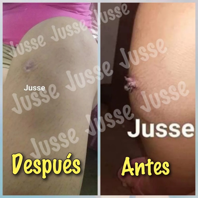 Jusse Anti Verrugas Lunares Mezquinos 15 Ml Sin Perfumar