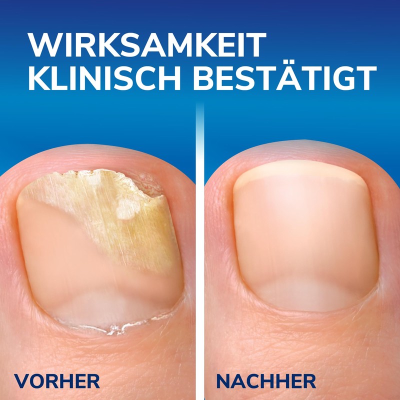 Scholl 2-in-1 Pen for Nail Fungus