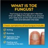 Fungi Nail 1oz Solution, With Brush