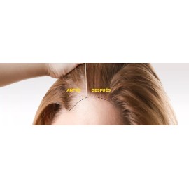 Alopex Tratamiento Alopex Para Dama