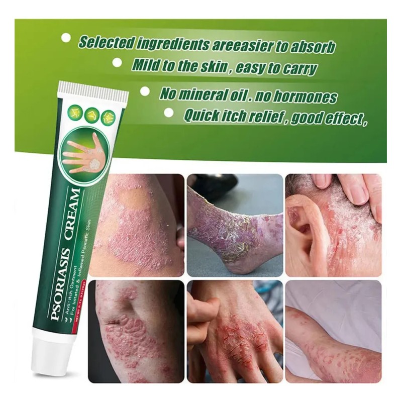 Maquillaje Para La Psoriasis Según Lo Descrito\ R\nreutiliza