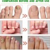 Ginger Nail, Tratamiento de Uñas con Jengibre, Soporte para Uñas,
