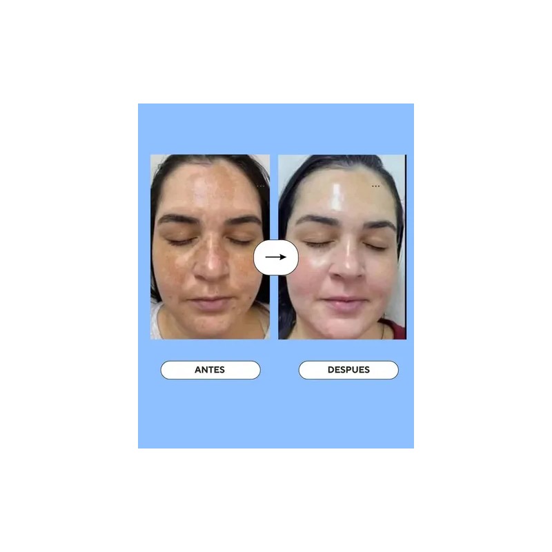 Serum Despigmentante Quita Manchas Con Vitamina C