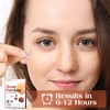 AUSLKA Acne Pimple Patches (175 Patches), Hydrocolloid Acne Pimple Patch
