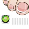 Ingrown Toenail Treatment Kit Glue Free Pedicure Ingrown Toenail Corrective