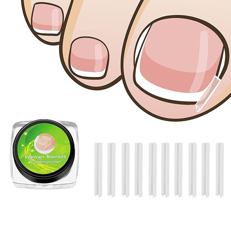 Ingrown Toenail Treatment Kit Glue Free Pedicure Ingrown Toenail Corrective