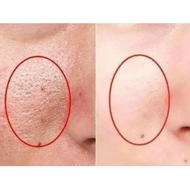 5 ShangHai Sulfur Soap Acne Blemish Anti-Mites Itch Excess Oil