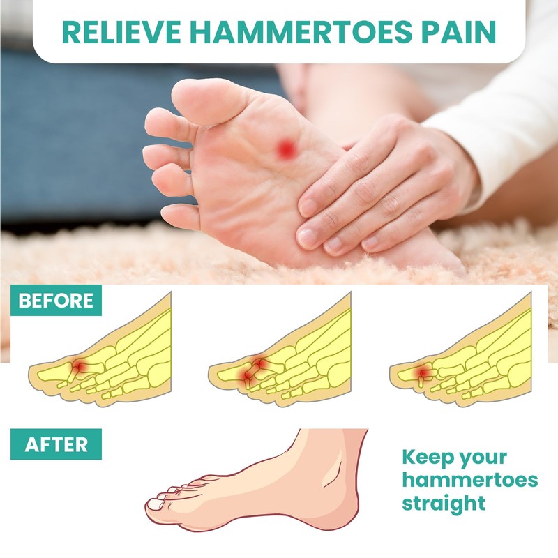 Welnove Hammer Toe Straightener Toe Corrector for Women - 8