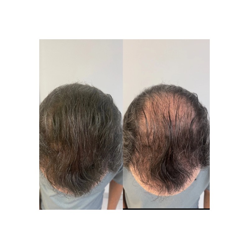 Hair Building Fibers Refill Dark Brown 25g Thinning Hair Concealer