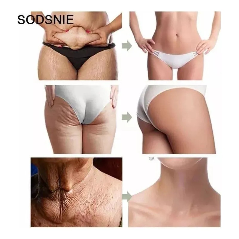 Adelgaza Abdomen Quemagrasa Celulitis Estrias Piernas Gluteo Neutra