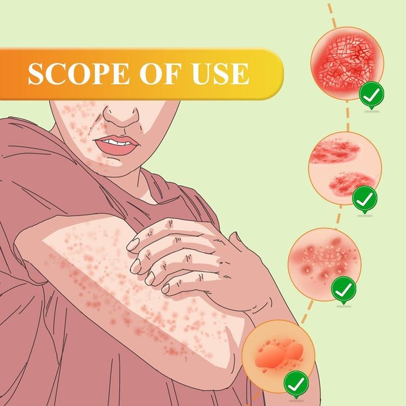 South Moon Bee Venom Psoriasis Cream, Skin Hand Moss Moisturizing