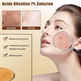 Ácido Glicólico 7% Solución 240ML, Ácido Glicólico 7% Tonifica, Exfolia, Reduce las Marcas del Acné y los Granitos, Rejuvenece la Piel, Un Tónico Facial que lumina tu Cutis.