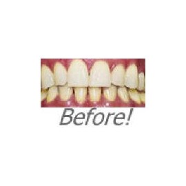 SEALED-INSTANT WHITE SMILE'S optimzed 60ml 36% Carbamide Peroxide Teeth Whitening Gel KIT-Professional Dentist Strength Gel KIT with 2 SETS OF TRAYS SEALED