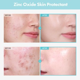 TOSOWOONG SOS Repair CICA Clinic Zinc Cream, 100,000ppm Zinc Oxide, Heal, Soothe Acne, Redness, Rosacea Treatment, Skin Barrier Repair, Moisture, Non-Comedogenic, Korean Skin care, 50g, 1.76 oz.