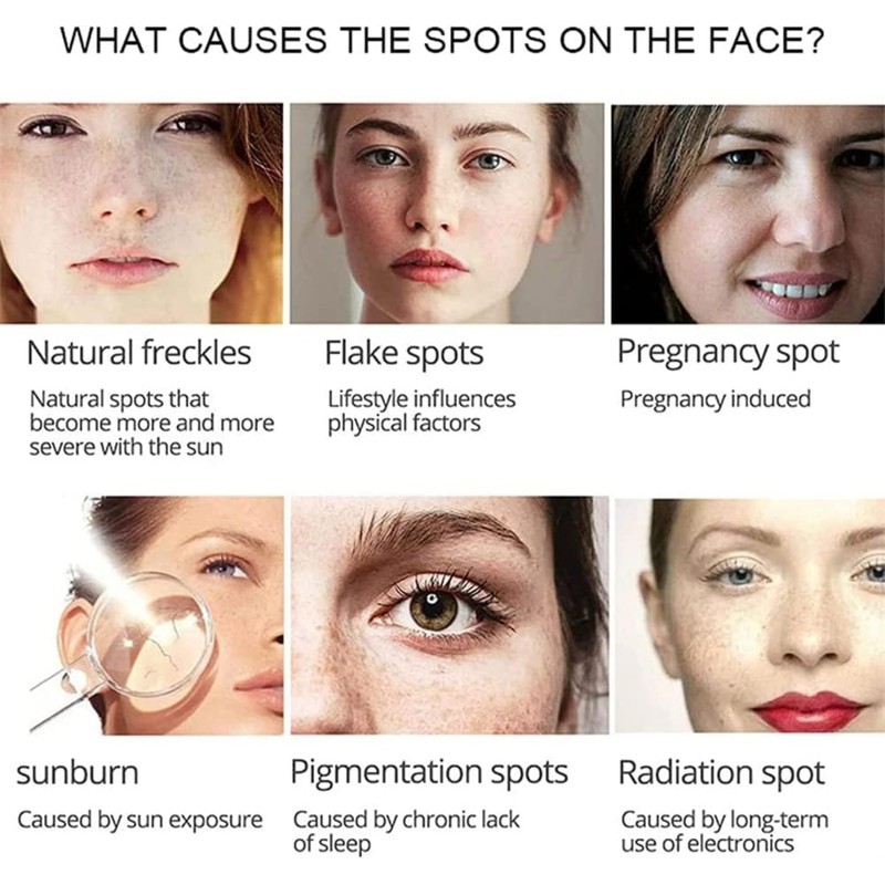 Crema para Manchas Oscuras en La Cara, Cremas para Quitar