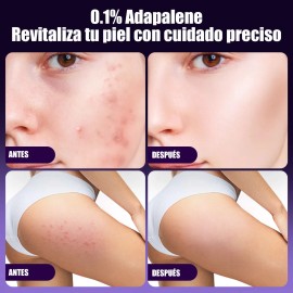 Gel Facial Anti Piel Acne Contiene Adapalene Todo Tipo Día Noche