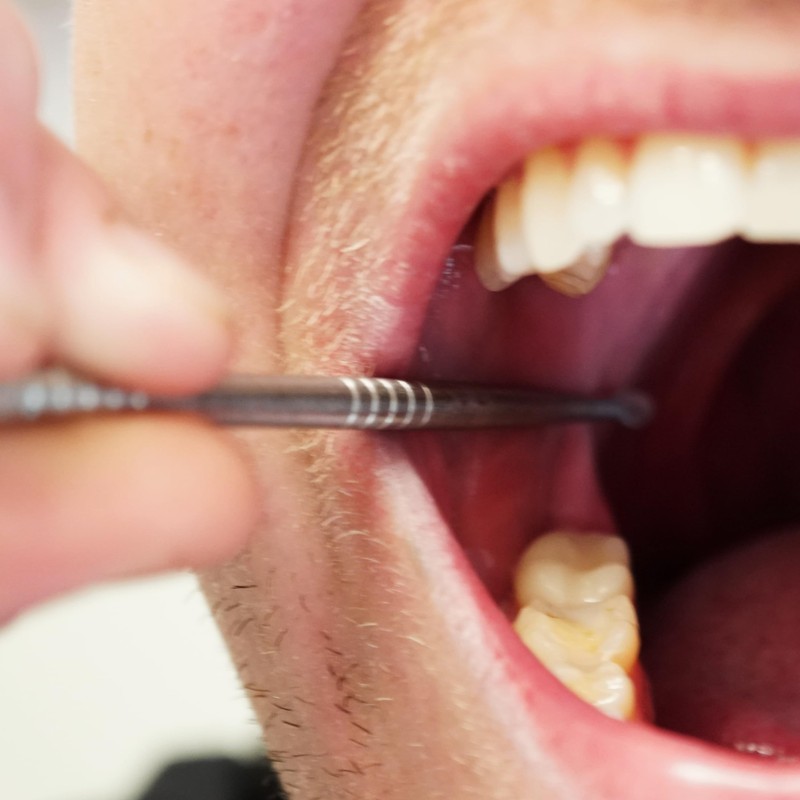 Generic Premium Tonsil Stone Remover Kit, Metallic