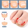 Comfortable Ingrown Toenails Set, with 90 Toenail Correction Patch &
