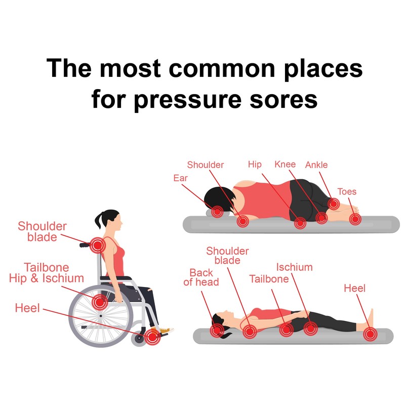 TriDerma Pressure Sore Relief Healing Cream Pack of (4) 4