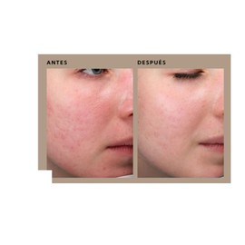 Serum PDRN de DNA de Salmón 50ml | Ampolla Facial de Salmón con Extracto de DNA de Salmón Rey, Colágeno Hidrolizado y Ácido Hialurónico para Reafirmar