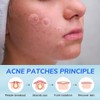 KOLZEMV Large Pimple Patches in 5 Sizes for Large Pimples,