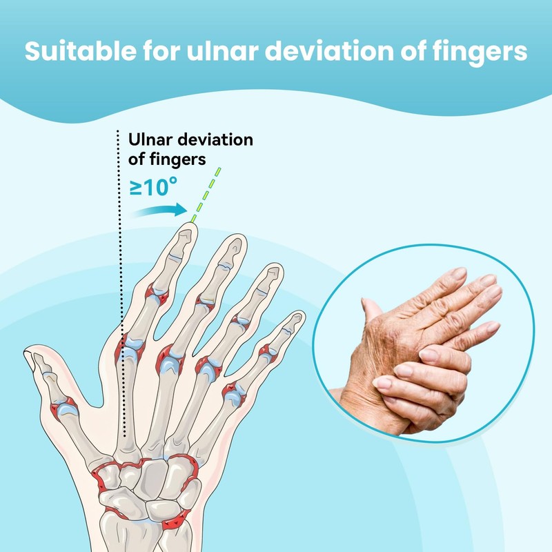 DrFinger Finger Ulnar Deviation Splint Brace, Finger Joint Deviation Orthopedic
