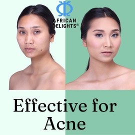 African Delights Herbal Black Soap Bar – Organic Soap for Acne & Sensitive Skin, Traditional Skincare from Ghana, Face & Body Cleanser, Jabon Negro Africano