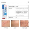 Gel Anti-acné Tratamiento Elimina Barros Ácido Salicíl