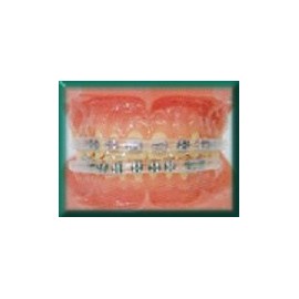 Morgan Bumper Braces Cover Lip Protector Qty 2 - Clear