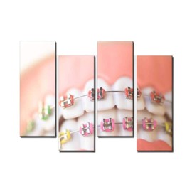 Wocatton cosmetic dentistry orthodontics dental metal wire teeth brackets Wall Art Background Decor Pictures Print On Canvas Art Stretched and Framed Perfect Home Decoration