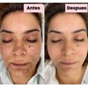 Generic Tonico Despigmentante LB *Elimina pecas, barros, paños, melasma*