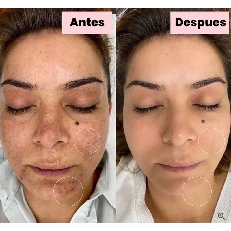 Generic Tonico Despigmentante LB *Elimina pecas, barros, paños, melasma*