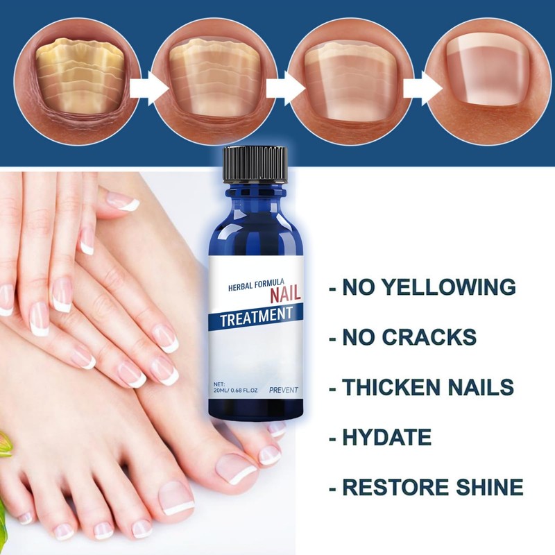 20ml Nail Treatment,Nail Treatment for Toenail Fingernails,Toenai-ls Extra Strong N-ail