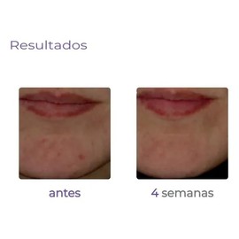 Sérum Derma&co. Derma Anti-acné -74% Acné Gb3 30 Ml. Acneica Día/noche