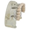 Ningfan Dental Implant Model,Implant All on 4 Overdenture Treatment Model,